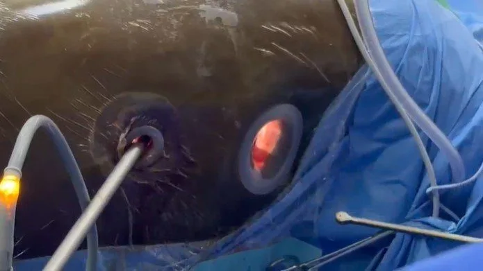 KNH Performs Kenya’s First Minimally Invasive Esophagectomy in Landmark Medical Milestone