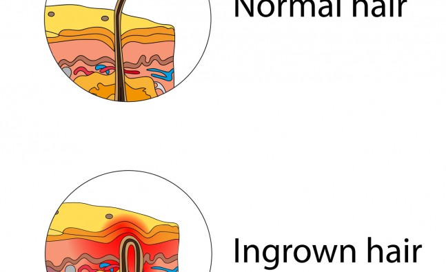 ingrown hairs
