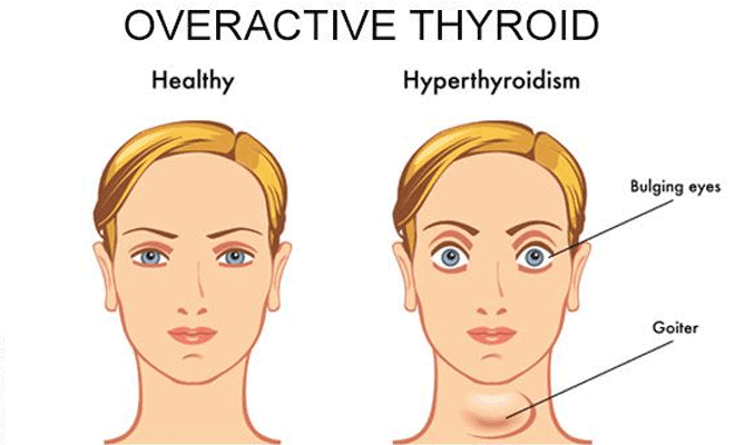 can-you-get-pregnant-if-you-have-overactive-thyroid-660x400