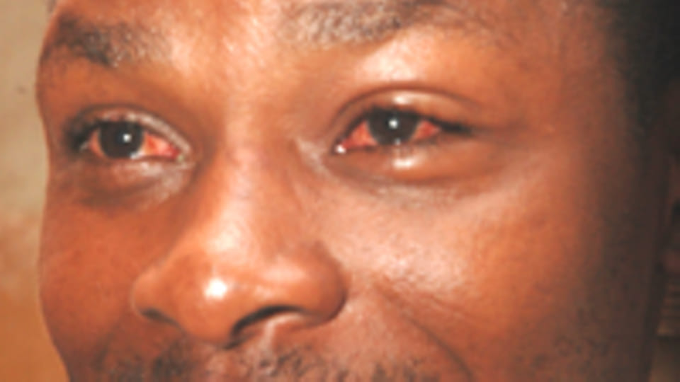 3 cases of Red Eye Disease reported in Nairobi – MOH