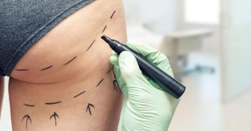 UK Bans Brazilian Butt Lift Ads Over Safety Concerns