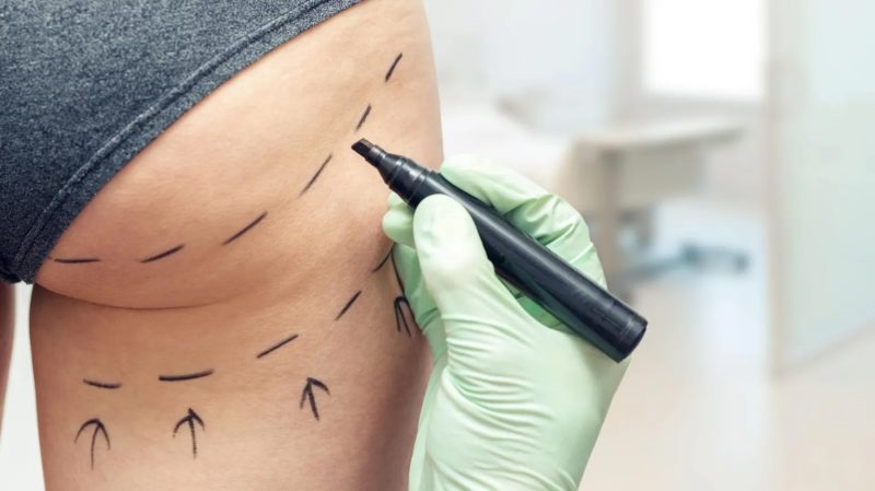 UK Bans Brazilian Butt Lift Ads Over Safety Concerns