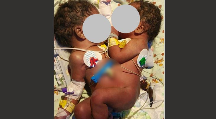 Conjoined twins with common large intestine survive surgery to create stool passage