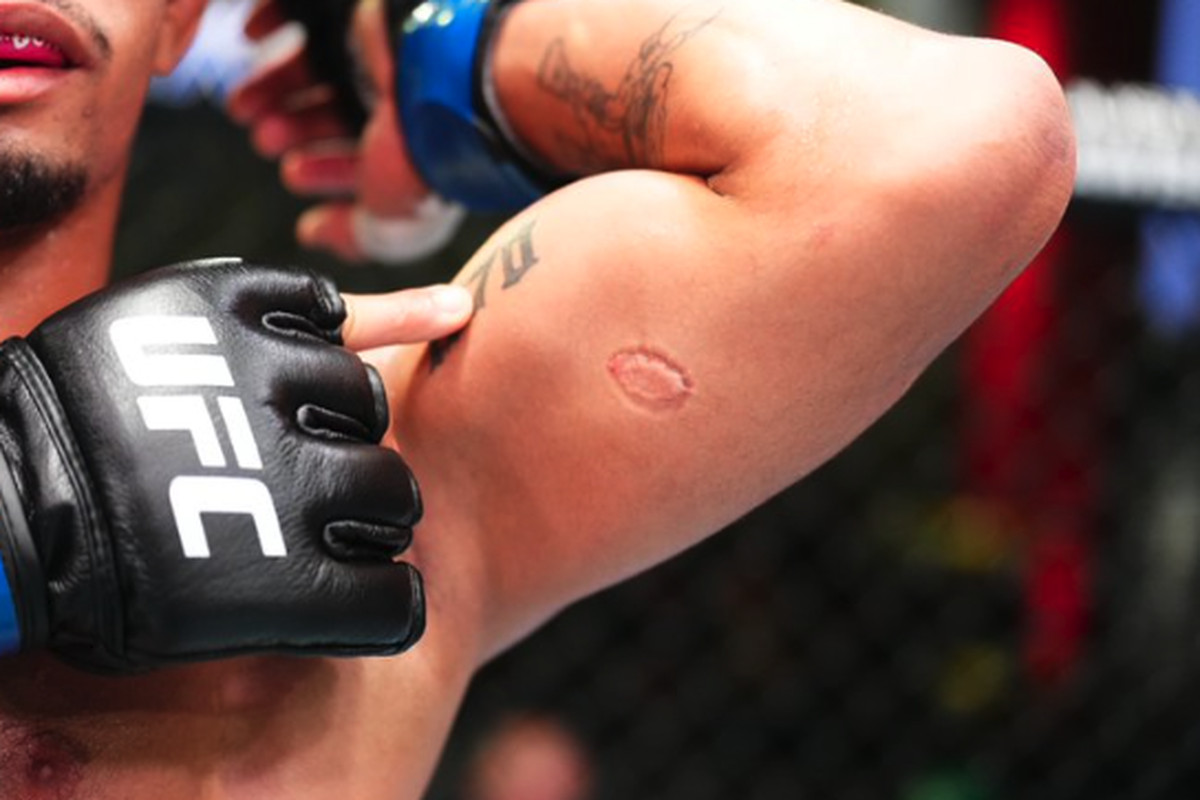 OUCH! – Brazilian UFC fighter disqualified for biting opponent